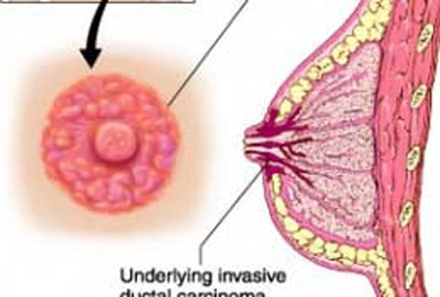 بیماری پگت که همه خانم ها باید بدانند در سایت علی نوروزی
