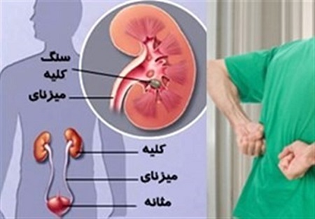 ارتباط مصرف کلسیم و لبنیات و سنگ کلیه در سایت علی نوروزی